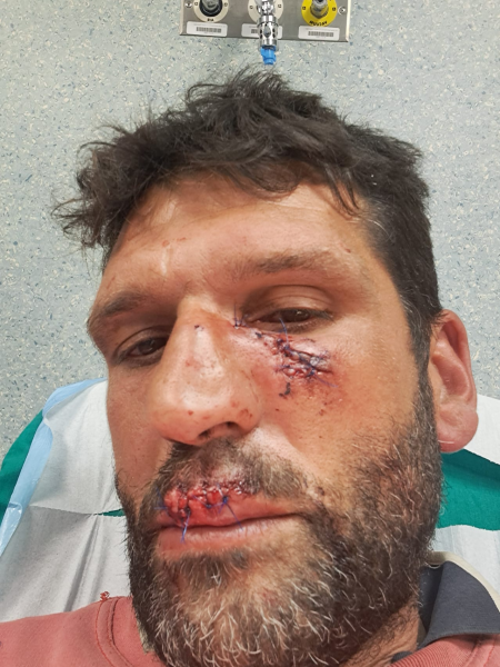 La storia di Francesco, aggredito da un lupo mentre lavora nel suo terreno a Castelnuovo - Foto